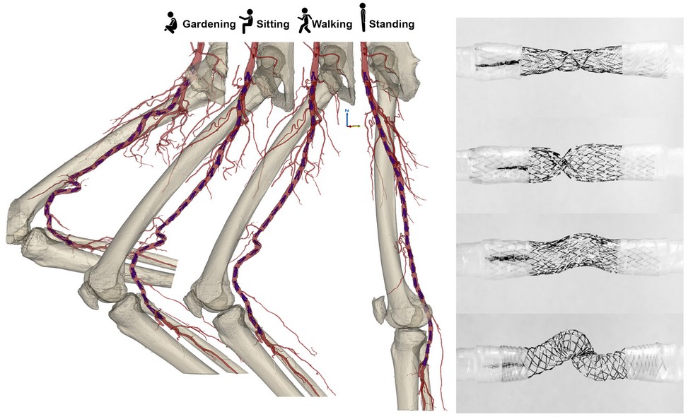 stents-for-peripheral-arterial-disease-1.jpg