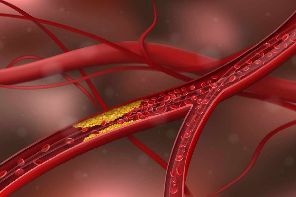 UNO-Led Team Pioneers First Catheter-Based Treatment to Eliminate Arterial Calcium